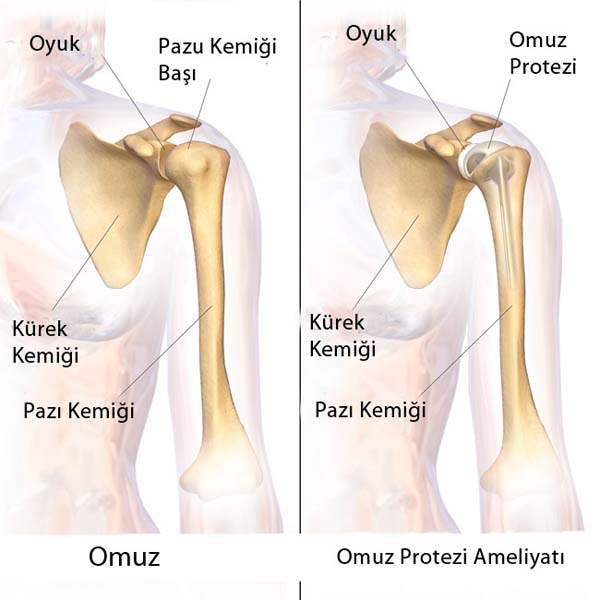 Tekrarlayıcı Omuz Çıkıkları