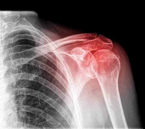 Donmuş Omuz (Frozen Shoulder)