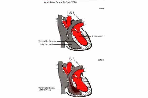 Ventriküler Septal Defekt