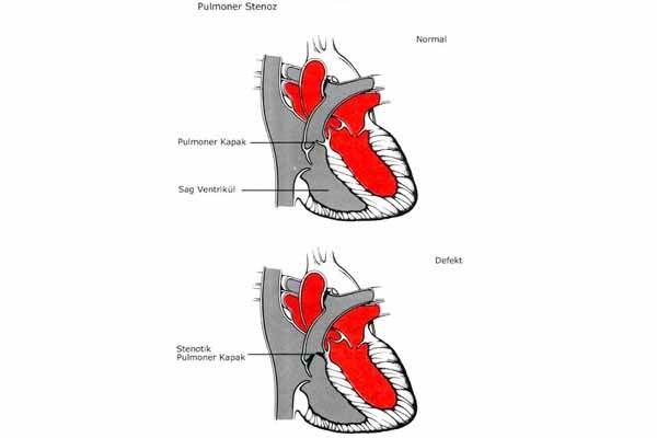 Pulmoner Stenoz (PS)