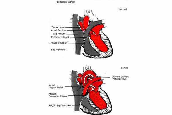 Pulmoner Atrezi (PA)