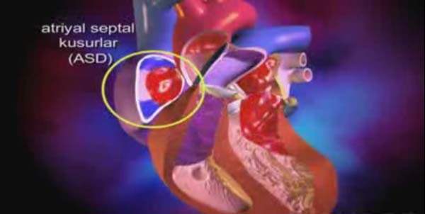 Atriyal Çırpınım (Atriyal Fibrilasyon)