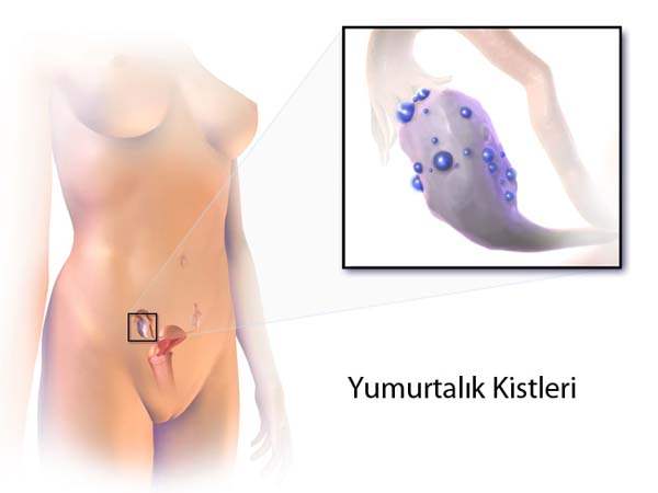 Yumurtalık Kistleri