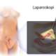 Tanısal Laparoskopi