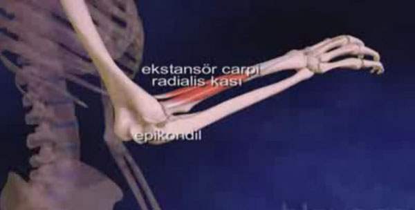 Tenisçi Dirseği