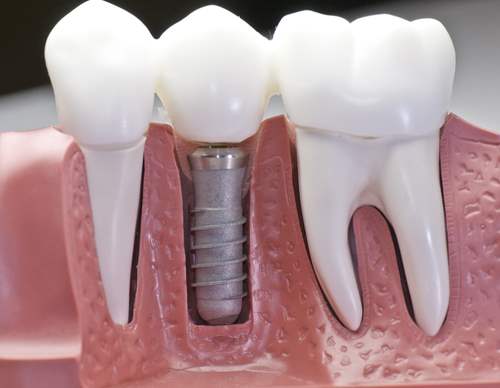 Diş Hekimliğinin Yükselen Trendi Diş İmplantları