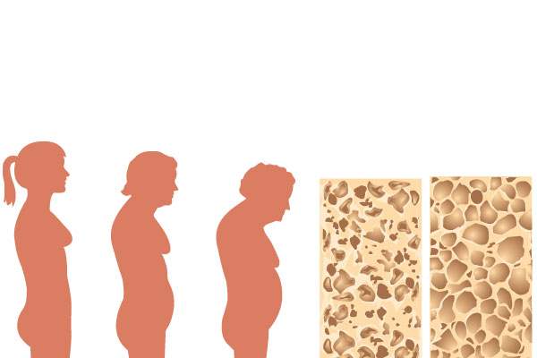 Araştırmalar osteoporoz genini saptamaya yardımcı oluyor