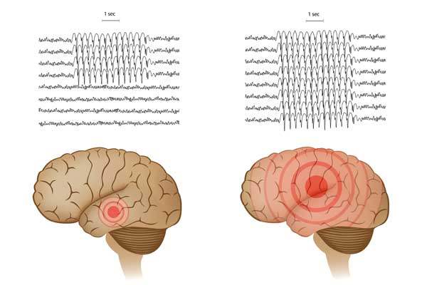 Epilepsi için Görsel Kılavuz