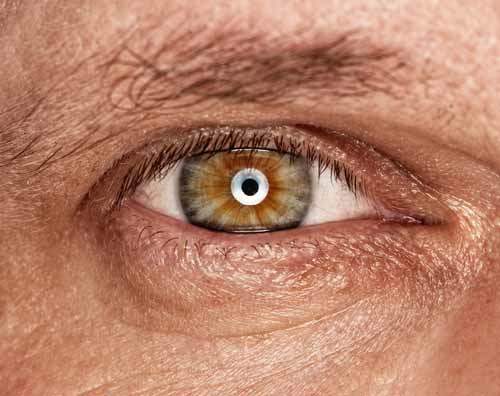 Göz Melanomunun Nedenleri Nelerdir?