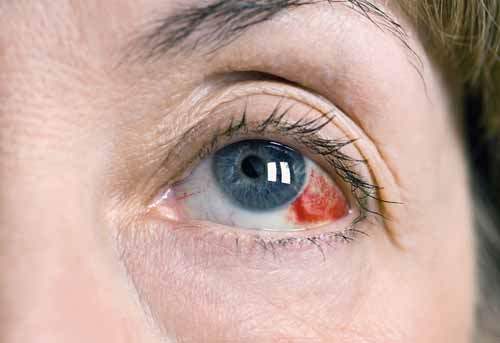 Göz melanomunun neden olduğu sağlık sorunları nelerdir?
