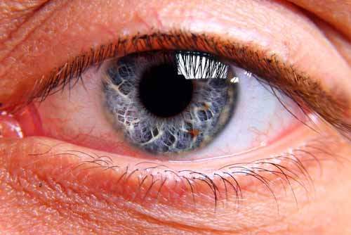 Göz melanomun teşhisi nasıldır?