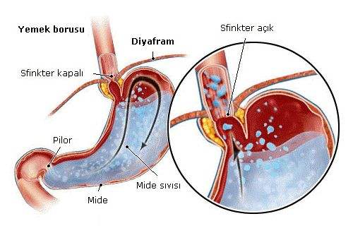 Gastrit Nedir?
