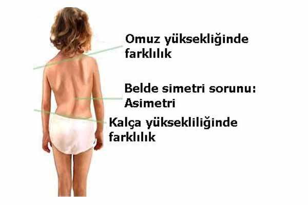 Progresif Çocuk Skolyozu Tedavisinde Yeni Gelişme