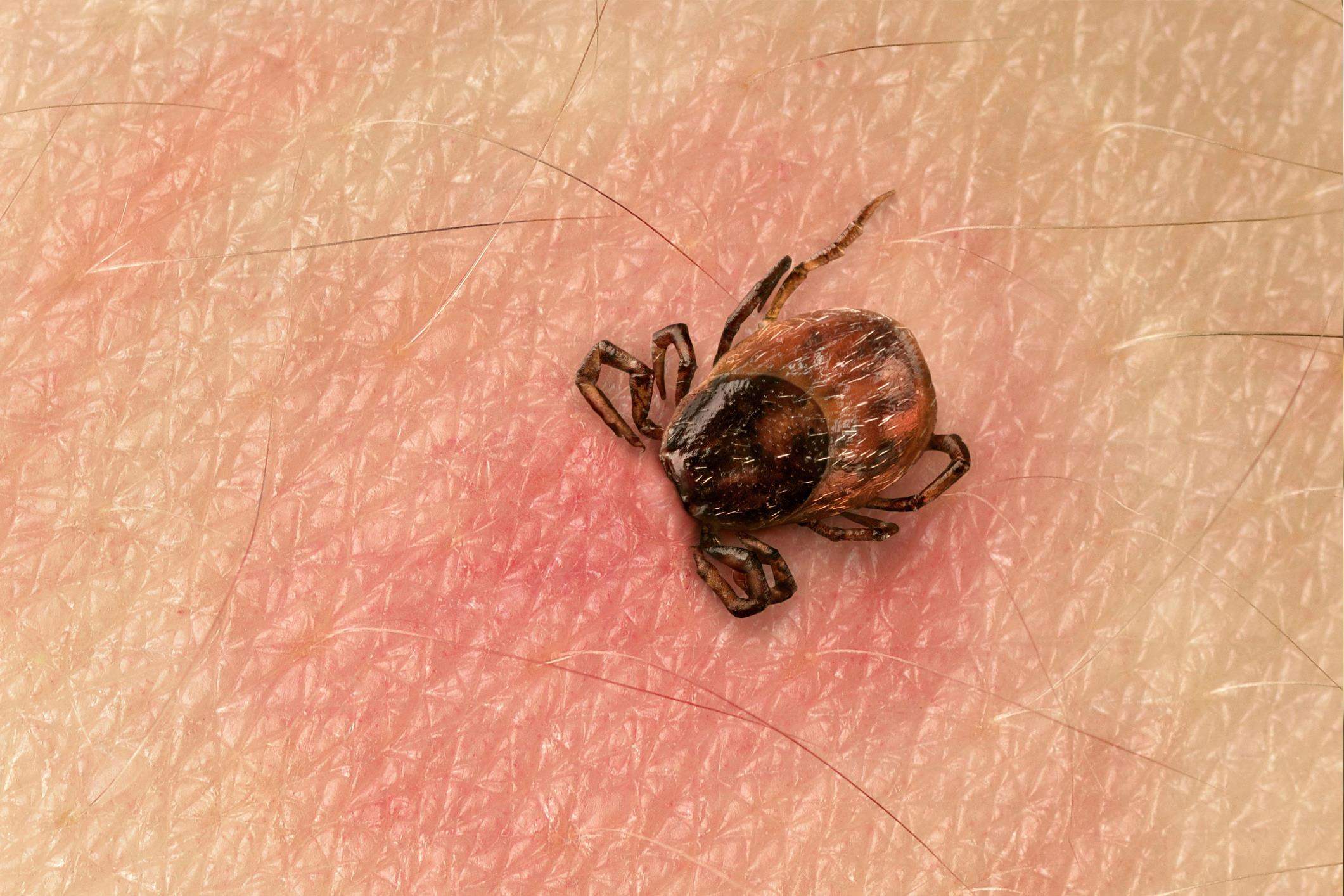 Lyme Hastalığı Nasıl Önlenir?