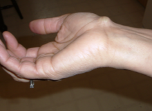 El Bileği Bölgesi Ganglionları (Kistleri) El Bileği Bölgesi Ganglionları (Kistleri)