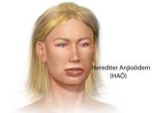 Anjioödem Anjioödem