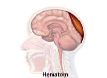 Auriküler Hematom (Güreşçi Kulağı) Auriküler Hematom (Güreşçi Kulağı)