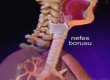 Bronşiyal Adenoma Bronşiyal Adenoma