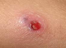 Chagas Hastalığı (Amerikan Triponozomiyasis) Chagas Hastalığı (Amerikan Triponozomiyasis)
