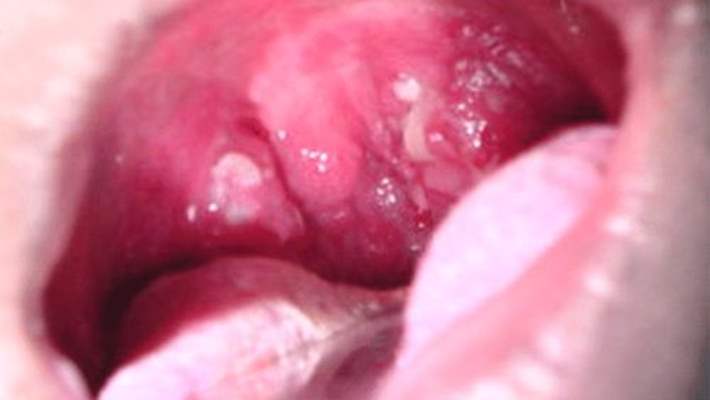 Boğaz İltihabına Karşı Evde Etkili Tedavi