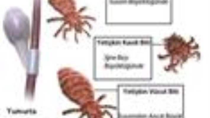 Vücut Bitlerinden Kurtulmanın Yolları