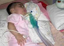 Gevşek Bebek Sendromu Tedavisinde Önemli Gelişme Gevşek Bebek Sendromu Tedavisinde Önemli Gelişme