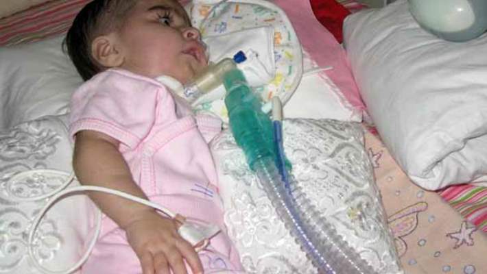 Gevşek Bebek Sendromu Tedavisinde Önemli Gelişme