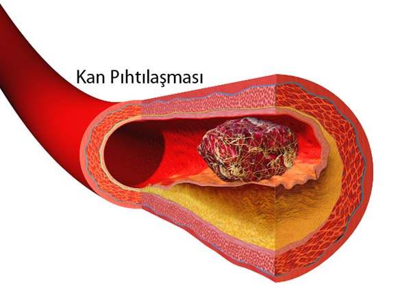 Kan Pıhtılaşma Bozuklukları