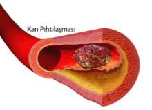 Kan Pıhtılaşma Bozuklukları
