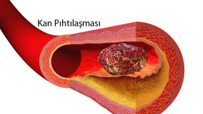 Kan Pıhtılaşma Bozuklukları