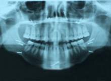 Kırık Çene Kemiği Kırık Çene Kemiği