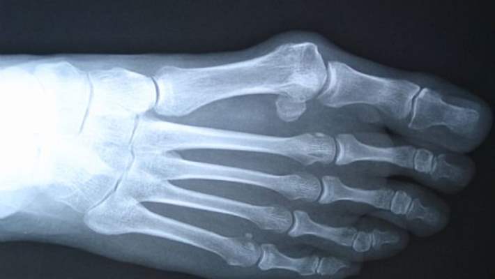 Paratroit Hormon Bozukluğu (Psödohipoparatiroidizm)