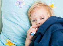 Çocuklarda üst solunum yolu enfeksiyonlarının tedavisi hangi yöntemle yapılır?
