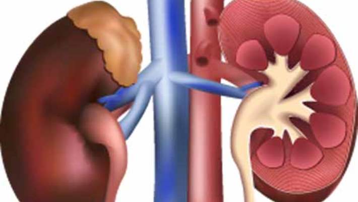 Araştırma Yaşayan Böbrek Donörlerinde Metabolik Sendromun Kalan Böbreğin Fonksiyonunu Kötüleştirdiğini Buldu