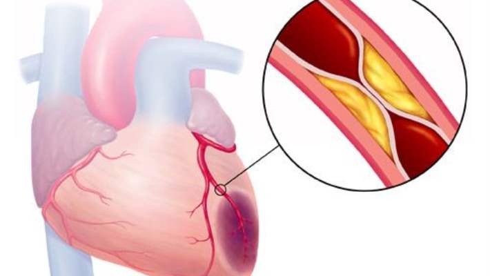 Atrial Çırpınımın Diğer Tedavileri