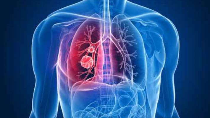 Akciğer Kanserinde Radyasyon Tedavisinin Yan Etkileri