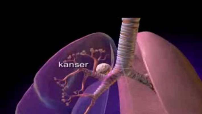 Hormonlar Akciğer Kanserinden Ölüm Riskini Artırıyor