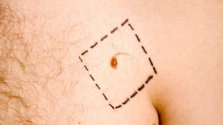 Bir Erkek Hasta, Bağışıklık Sisteminin Geliştirilmesiyle Melanomu Yendi