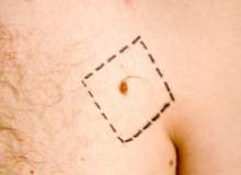 Melanom Ayak Tırnağını Etkileyebilir Melanom Ayak Tırnağını Etkileyebilir