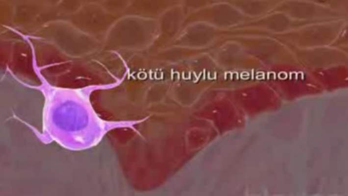 Melanom Türlerini Öğrenelim