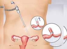 Robotik Cerrahi İle Yumurtalık Tüpü Açma Robotik Cerrahi İle Yumurtalık Tüpü Açma