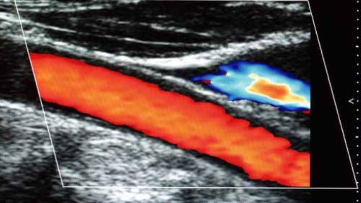 Doppler Ultrasonu