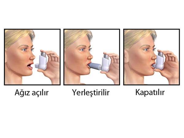 Solunum Problemleri: Ölçülü Doz İnhaler Kullanmak