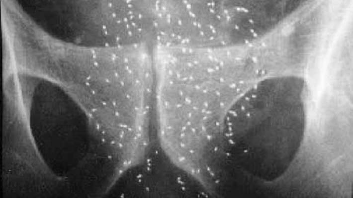 Prostat Kanseri İçin Brakiterapi