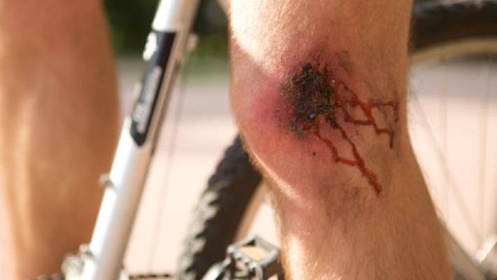 Diyabet: Yara Ve Sakatlıkların Tedavisi