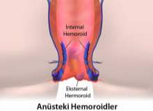 Hemoroidi Önlemenin Basit Yöntemleri