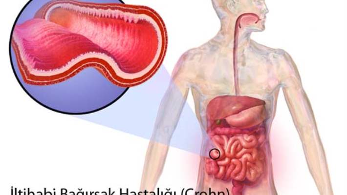 Crohn Hastalığıyla Kolon Kanseri Arasında Bir Bağlantı Var Mı?