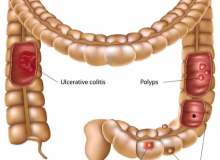 İltihabi Bağırsak Hastalığı (IBD) İltihabi Bağırsak Hastalığı (IBD)