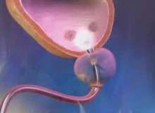 Sindirim Sorunları ve Üst Endoskopi Sindirim Sorunları ve Üst Endoskopi