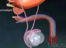 İyi huylu prostat hiperplazisi için açık prostatektomi İyi huylu prostat hiperplazisi için açık prostatektomi